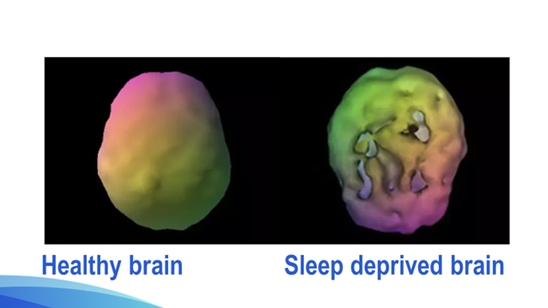 Impacts of sleep deprivation on brain health